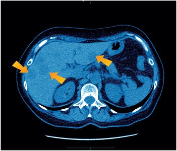 CT scan showing metastases in the liver
