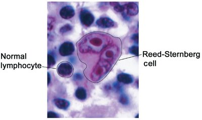 Microscopic image of Reed-Sternberg cell in Hodgkin lymphoma