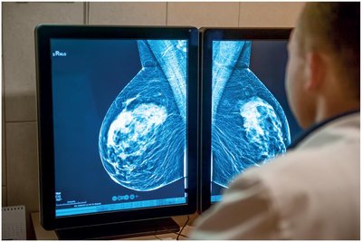 Mammogram showing adenocarcinoma of the breast