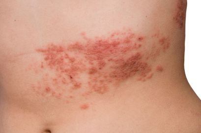 Shingles (herpes zoster) rash