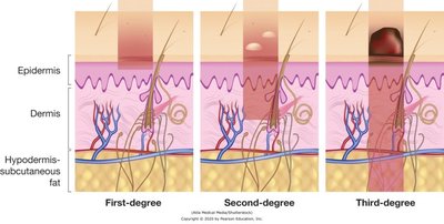 Diagram of first, second, and third-degree burns