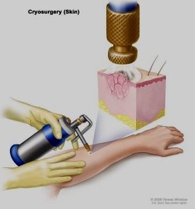 Cryosurgery procedure on the skin