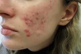 Acne on the face