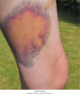 Ecchymosis (bruise) on the arm
