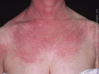 Erythema (redness of the skin)