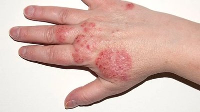 Eczema on the hand
