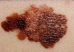 Malignant melanoma (skin cancer)