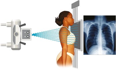 Posteroanterior chest x-ray