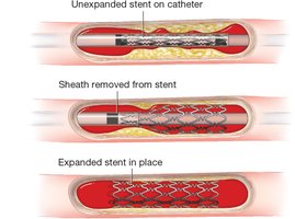 Stent placement