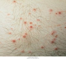 Flea bites