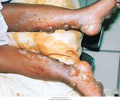 Second degree burn