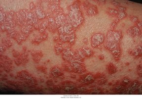 Psoriasis