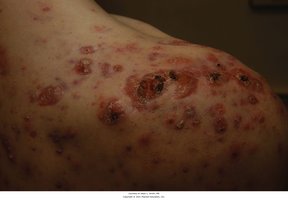 Acne fulminans