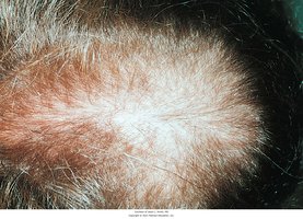 Androgenetic alopecia