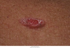 Basal cell carcinoma