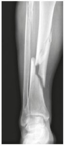 Fracture types illustration