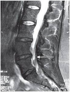 Abnormal spinal curvatures
