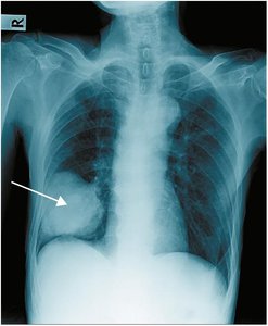 Chest x-ray showing atelectasis