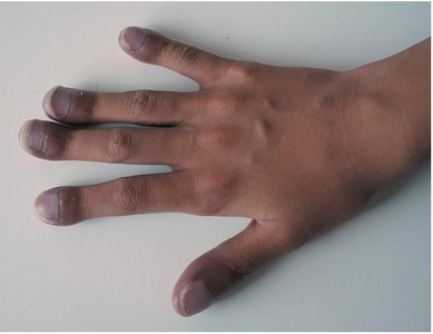 Clubbing of fingers in cystic fibrosis