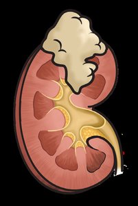 Wilms tumor in kidney
