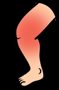 Edema in leg for thiazide