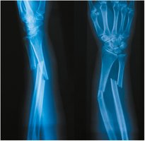 X-ray of a forearm fracture involving radius and ulna