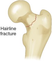 Hairline fracture illustration