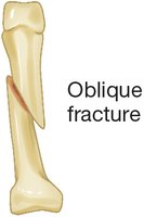 Oblique fracture illustration