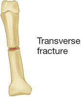 Transverse fracture illustration