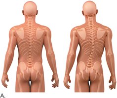 Comparison of normal and scoliotic spine