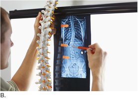 X-ray and model used to measure scoliosis