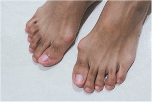 Feet with hallux valgus and bunions