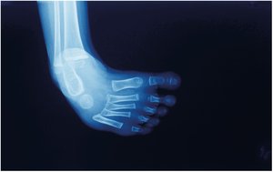 X-ray of a clubfoot