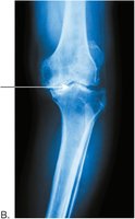 Osteoarthritic knee joint X-ray