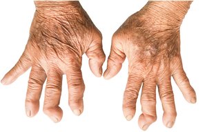 Hands with severe joint deformities from rheumatoid arthritis