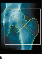 DEXA scan image of the hip