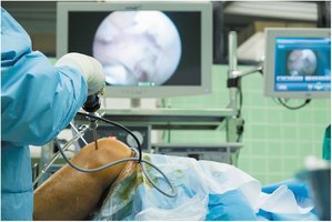 Arthroscopic surgery of the knee joint