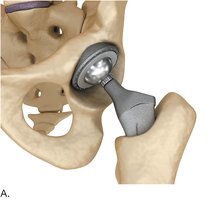 Illustration of a hip prosthesis in place
