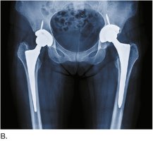 X-ray of bilateral hip prostheses