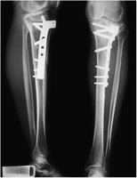 X-rays showing orthopedic plate and screws in the tibia