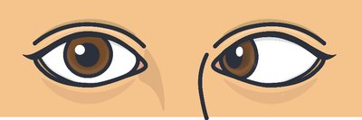 Optic nerve damage in glaucoma