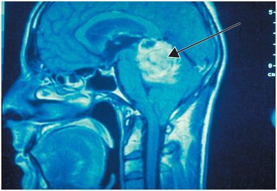 MRI showing astrocytoma in the brain