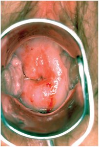 Cervix with areas of cervical dysplasia