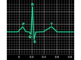 ECG Waveform