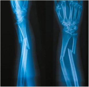 X-ray of a forearm fracture involving radius and ulna