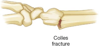 Colles fracture illustration