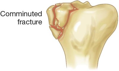 Comminuted fracture illustration