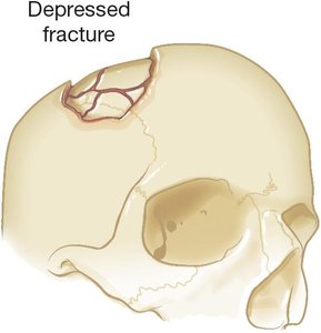 Depressed fracture illustration