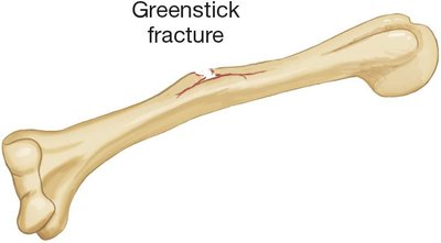 Greenstick fracture illustration