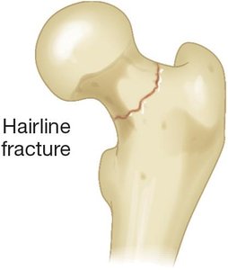 Hairline fracture illustration